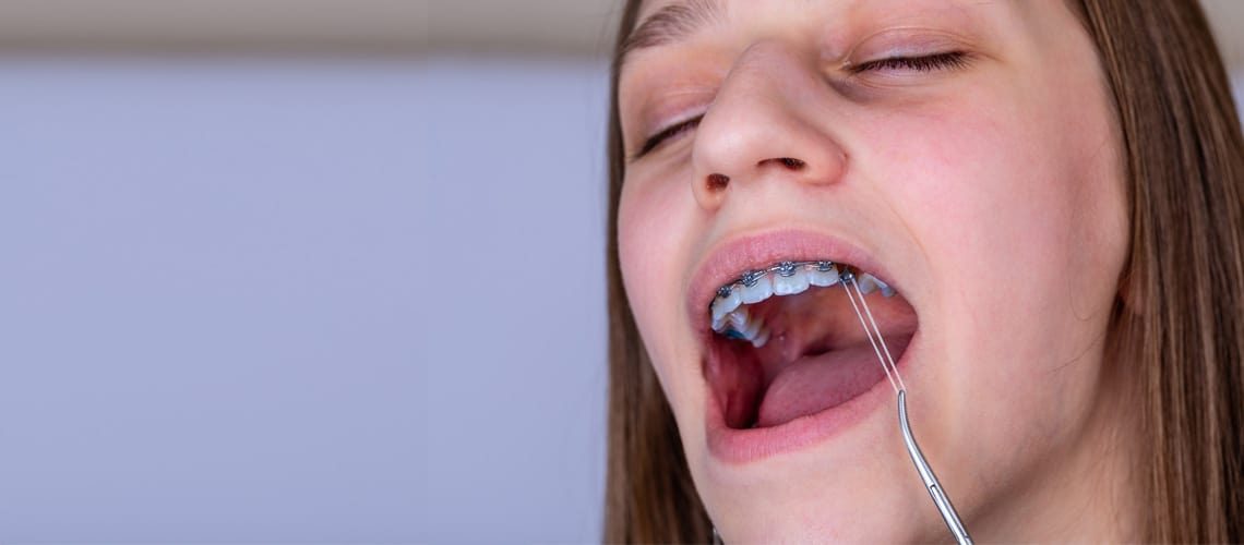 How to and why wear your elastic orthodontic bands, Elastic instructions  for braces are here